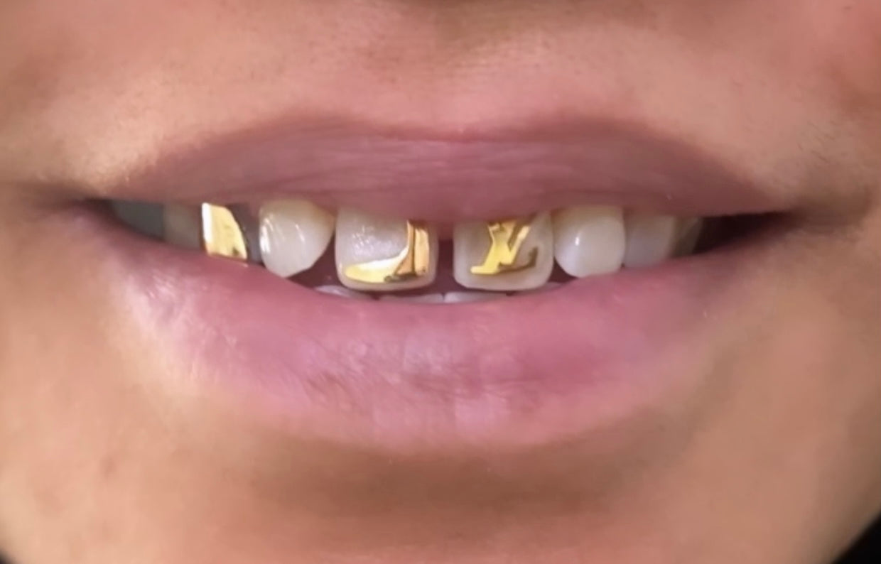 18k Gold Tooth Caps bundle - Main Image